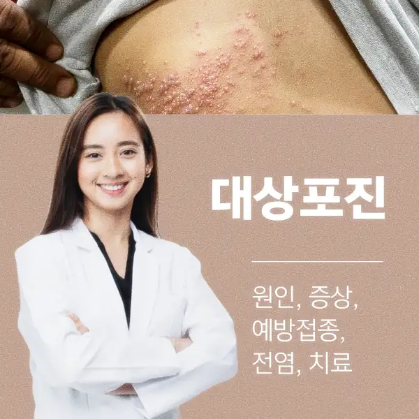 대상포진 원인, 증상, 예방접종, 전염, 치료