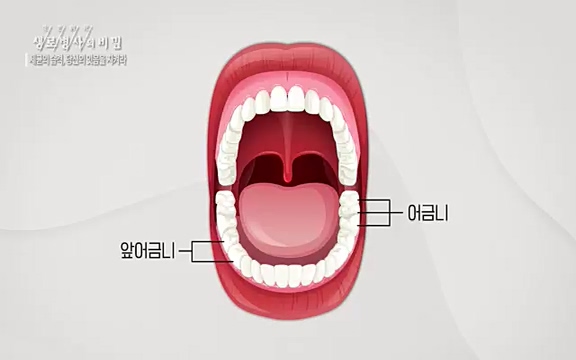 [792회] 생로병사의 비밀 - KBS[세균의 습격, 당신의 잇몸을 지켜라!] 감기보다 병원을 더 자주 찾게 만드는 질병이 있다. 바로 치주질환이다. 2020년 외래 다빈도 질병 1위를 차지한 치은염 및 치주질환 환자는 1,637_20220505_141607.777.jpg