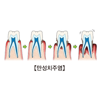 만성 이미지
