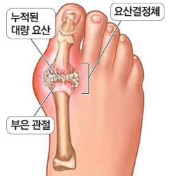  통풍 원인 증상 예방 치료 등 팁 알아보자