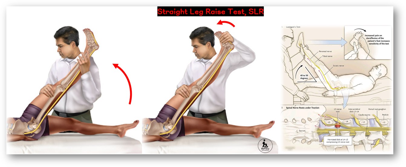 Straight leg raise test&#44; SLR test(하지 직거상 검사)