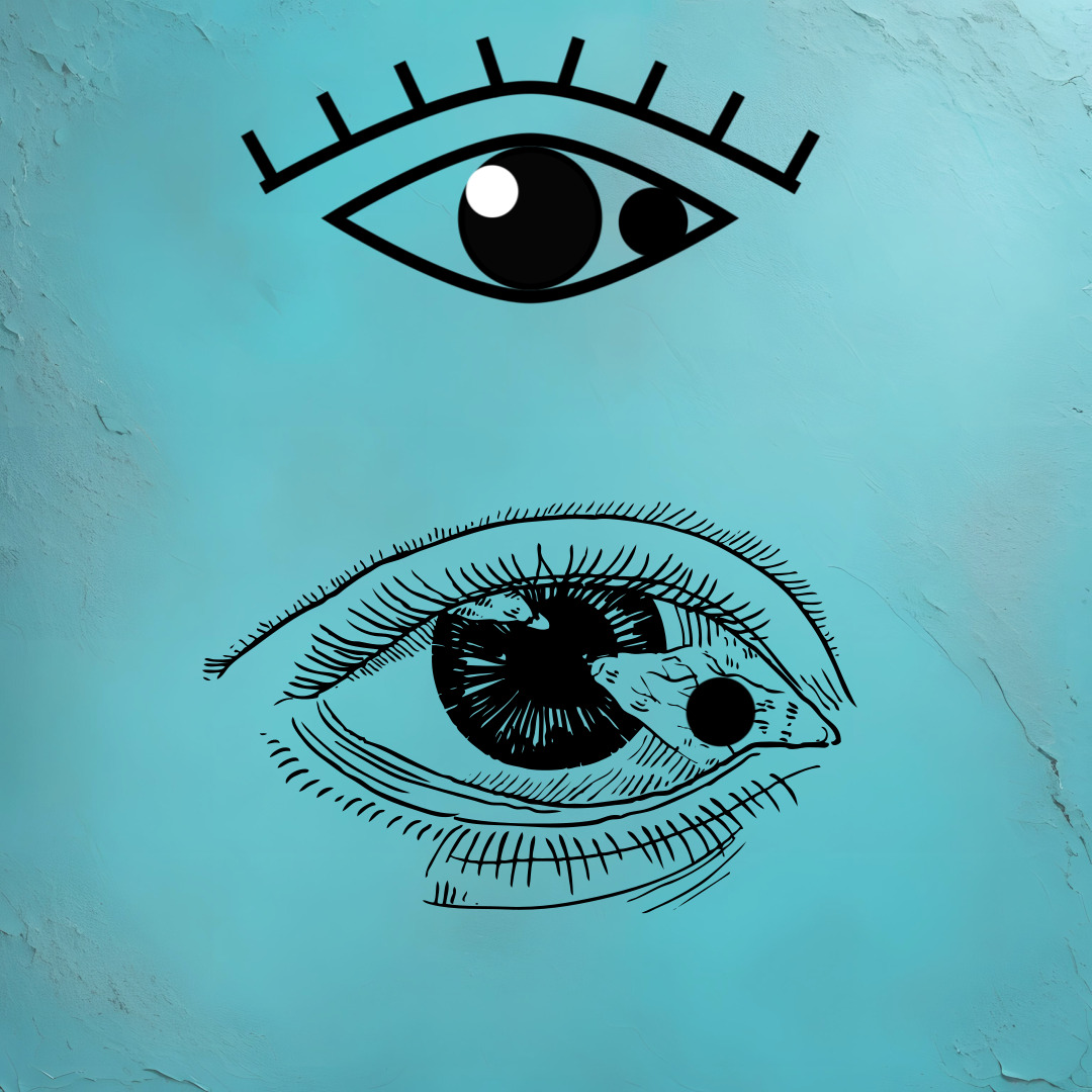 결막모반 그림