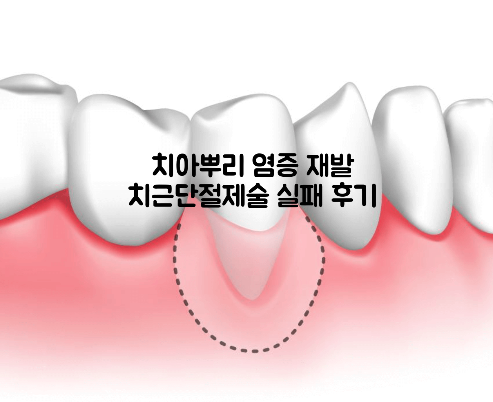 치아뿌리 염증