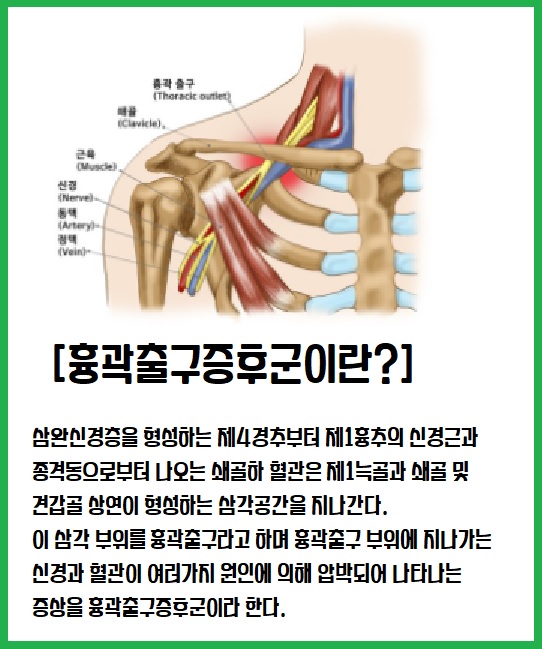 흉곽출구증후군