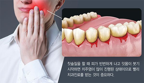 치주질환과 남성 기능저하의 원인 -치주질환