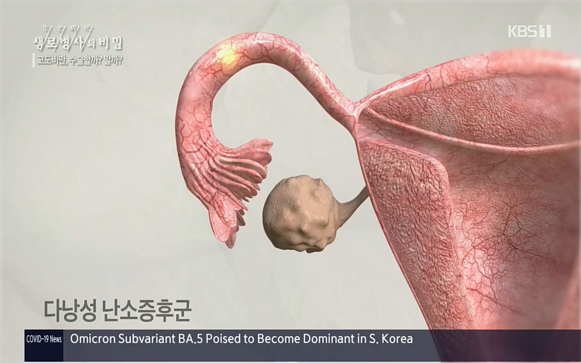생로병사의 비밀.E828.220728p.H264-F1RST.mp4_20220728_204817.740.jpg