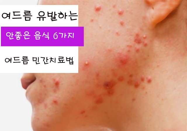 여드름을 유발하는 안 좋은 음식 6가지