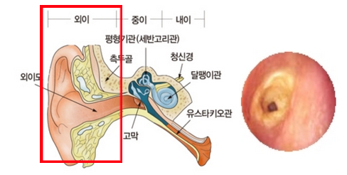귀의 기관 도해 및 염증 형태