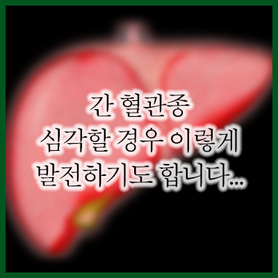 간 혈관종 원인&#44; 증상&#44; 치료에 대해서 알아보았습니다.