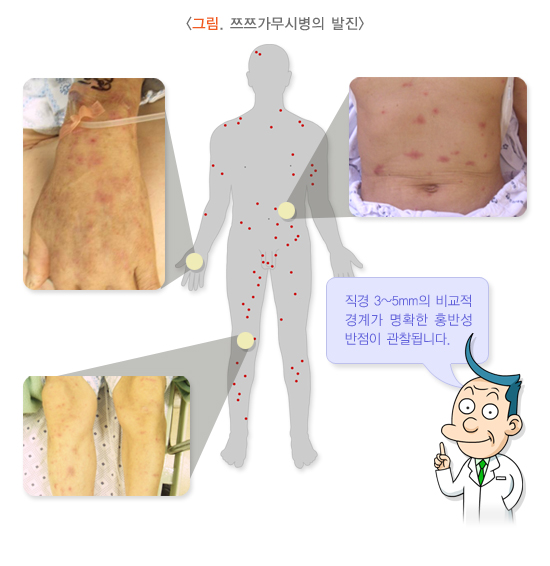 쯔쯔가무시병의 발진