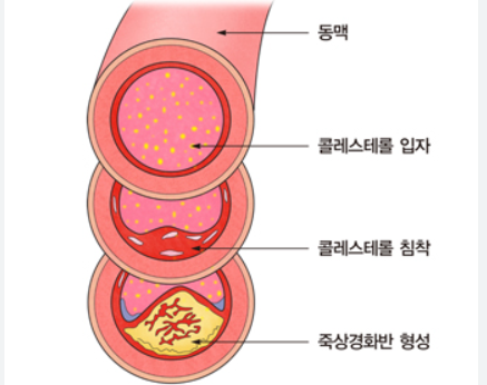 죽상경화증의 진행과 예방