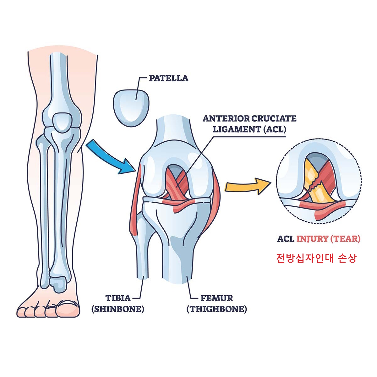 전방십자인대 손상