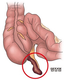 급성-충수염