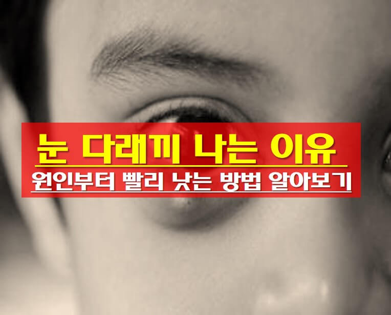  눈 다래끼 나는 이유 , 원인부터 빨리 낫는 방법 알아보기