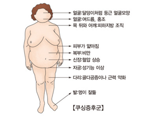 쿠싱증후군 증상과 치료