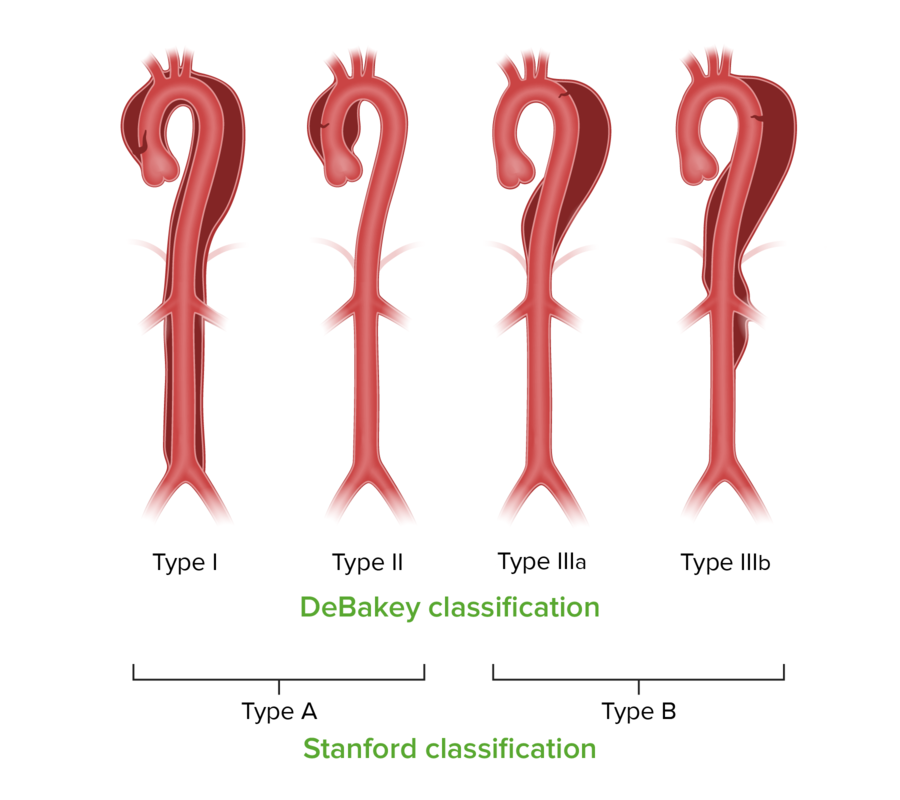  대동맥 박리(Aortic dissection) : 대동맥 박리란? 대동맥 박리 증상, 갑자기 심한 가슴통증, 소변 색 변화