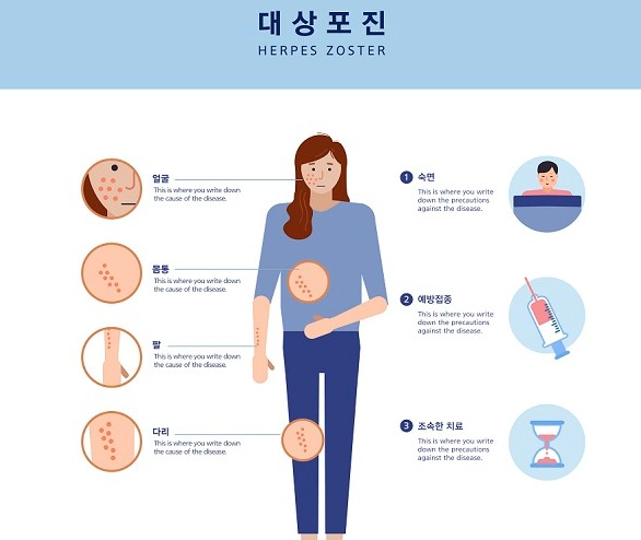  대상포진의 원인과 증상 예방 및 치료법