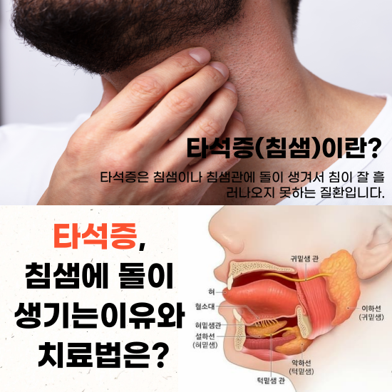 타석증