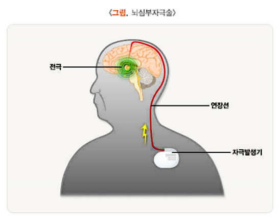 파킨스-이미지