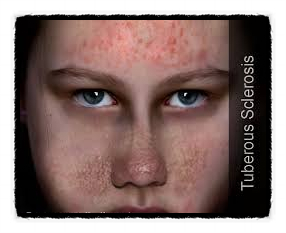  "결절성 경화증"(Tuberous Sclerosis")