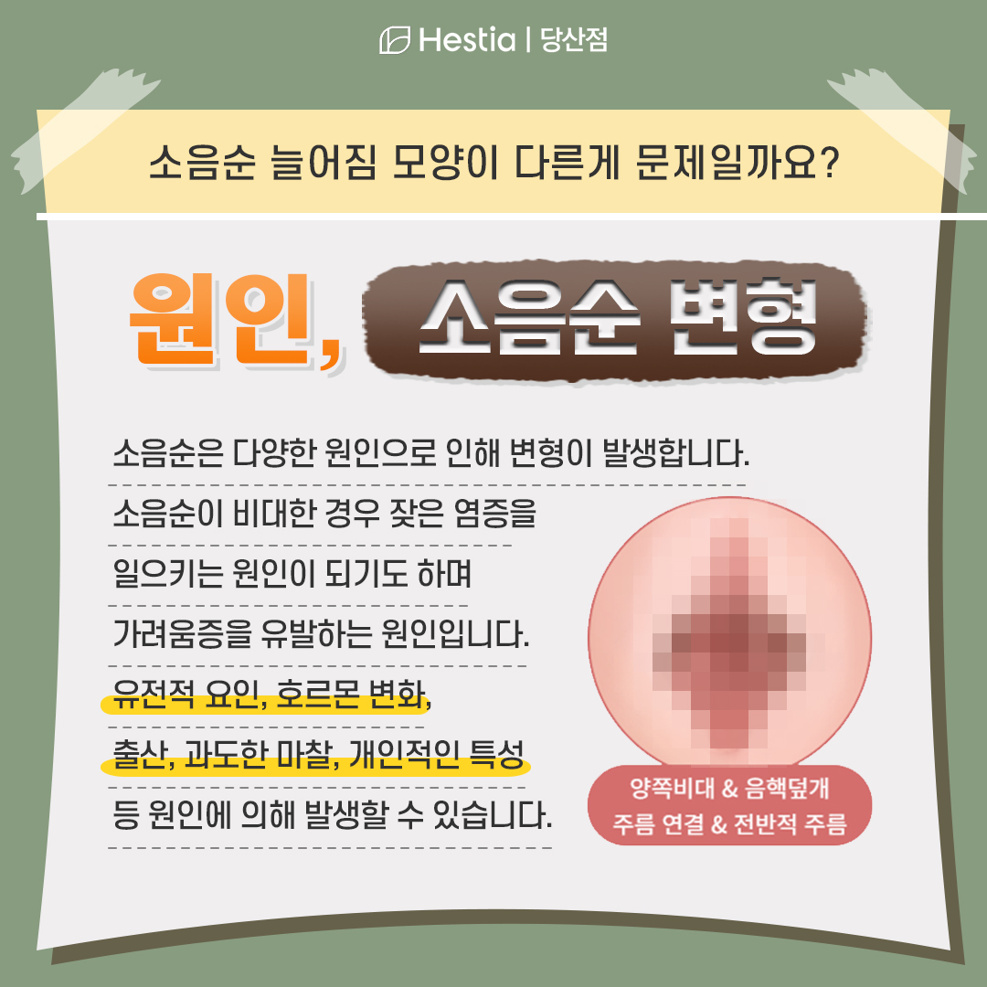 소음순 모양 늘어짐이 문제인가요?