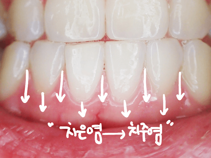 치은염-치주염-경과에-따른-잇몸-변화