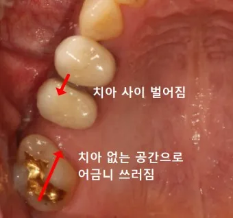 어금니 칫솔 사용법 선택방법 실사용 후기_21
