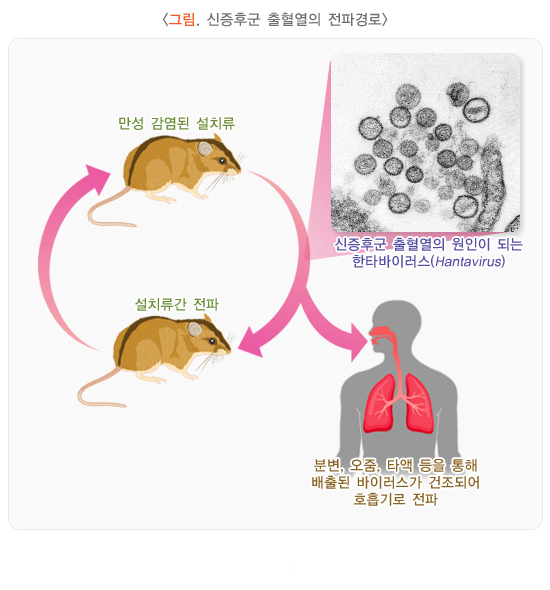  신증후군출혈열 증상 및 원인, 치료방법