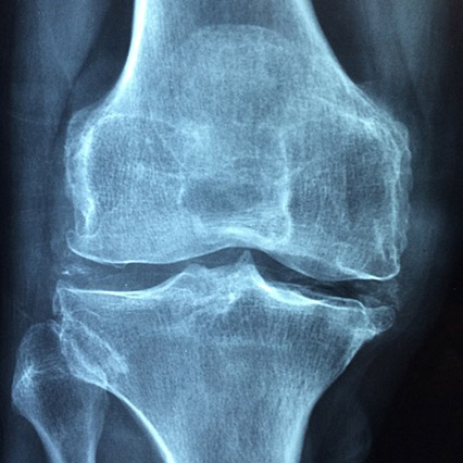 무릎바깥쪽통증