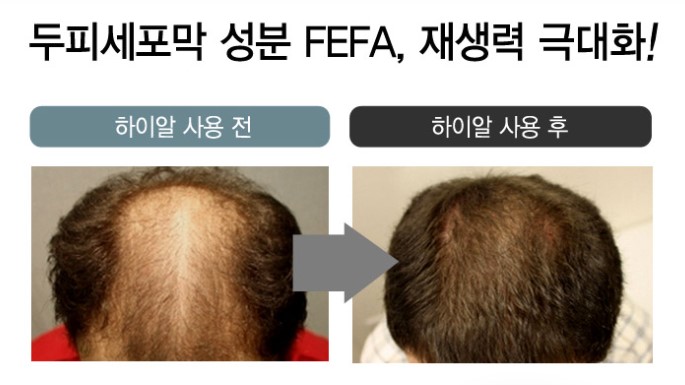 머리 굵어지는 법 모근강화영양제 탈모에 좋은 보충제 제르넬 2