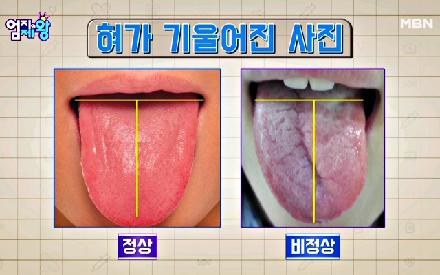 혀로 보는 뇌졸중 초기증상, 혀 기울기, 혀 건강체크, 혀 건강상태, 건강 팁줌 매일꿀정보