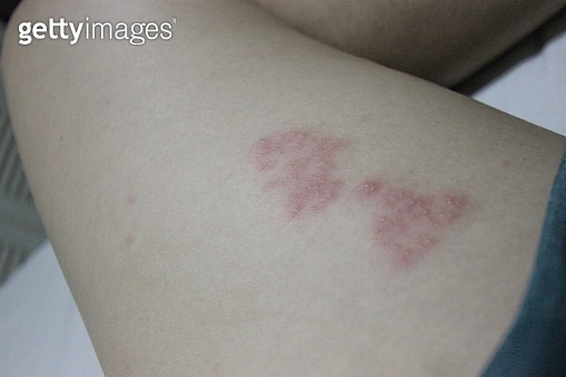 [질병후기] 대상포진 증상과 치료