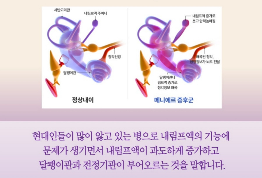 정상적인 내이와 메니에르 증후군이 있을 때의 내이의 상태를 비교하여 설명해주는 그림과 설명 사진