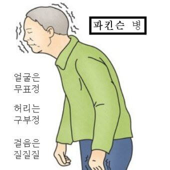  치매와 닮은 파킨슨 병의 원인, 초기 증상, 진단, 예방 및 치료제