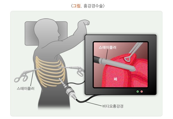 기흉수술