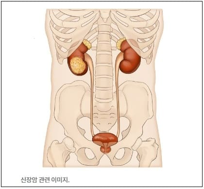 ‘착한 암’으로 불리는 이 암...요즘 왜 젊은 층에서 유난히 증가하나