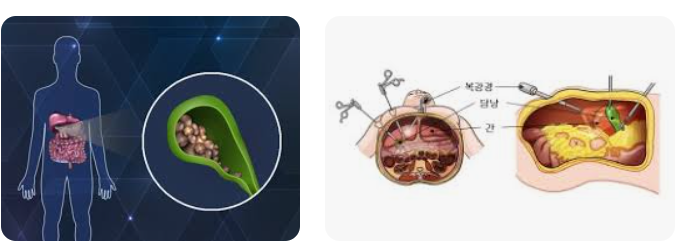 담석 제거 없이 관리할 수 있는 비수술적 방법