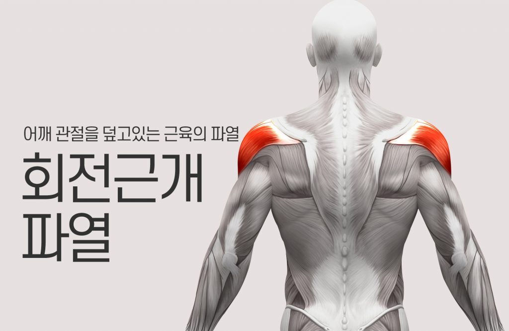 회전근개파열 운동&amp;#44; 증상&amp;#44; 치료 방법 Rotator Cuff Tear Treatment