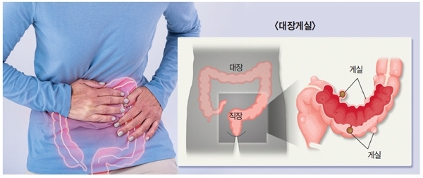 게실염 식단