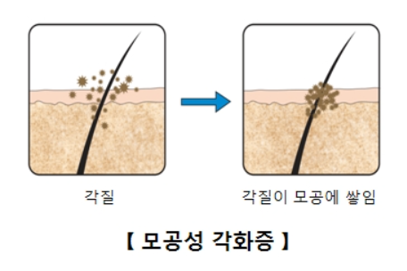 팔과 다리의 오돌토돌한 각질 닭살 피부 관리법