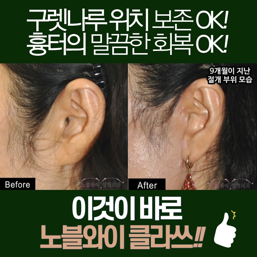  안면거상흉터 시기와 구렛나루 위치