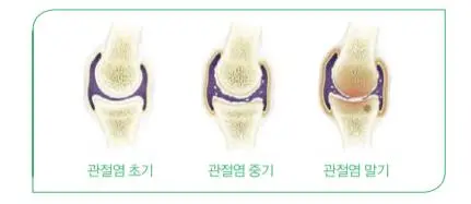 관절염