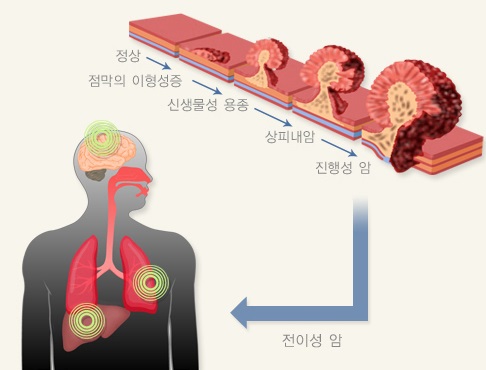 대장용종과 대장암