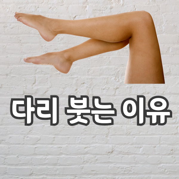 다리가 붓는 이유