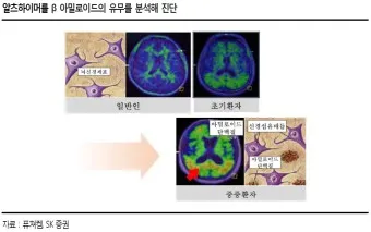 알츠하이머와 치매 차이_9