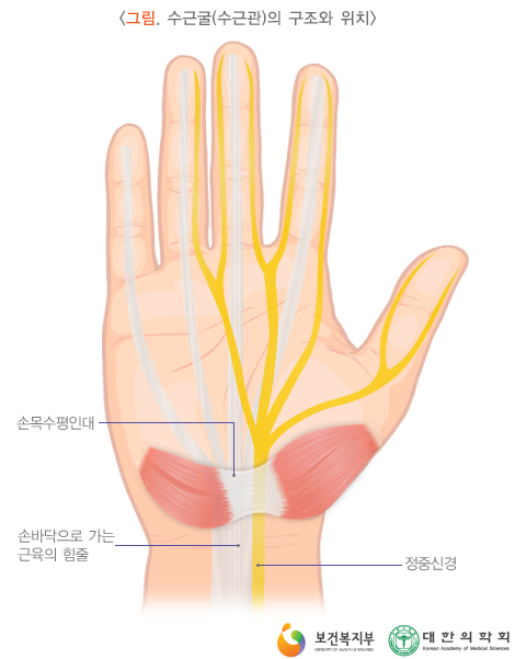  라온 건강이야기 -(손목터널증후군 (원인, 증상, 정의 편)-