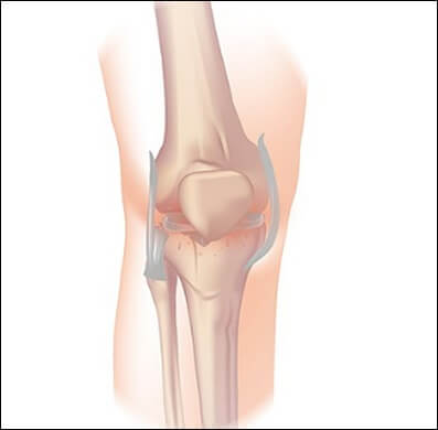 무릎관절과 연골사진