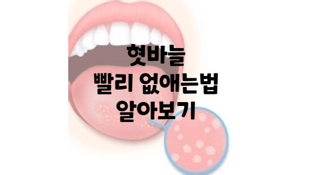  혓바늘 없애는 법 원인 정확하게 알아보고 빨리 낫자!