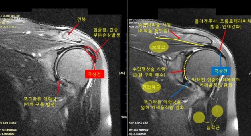  오십견 원인 증상, 비수술 또는 수술 어떤 어깨통증 치료 방법을?