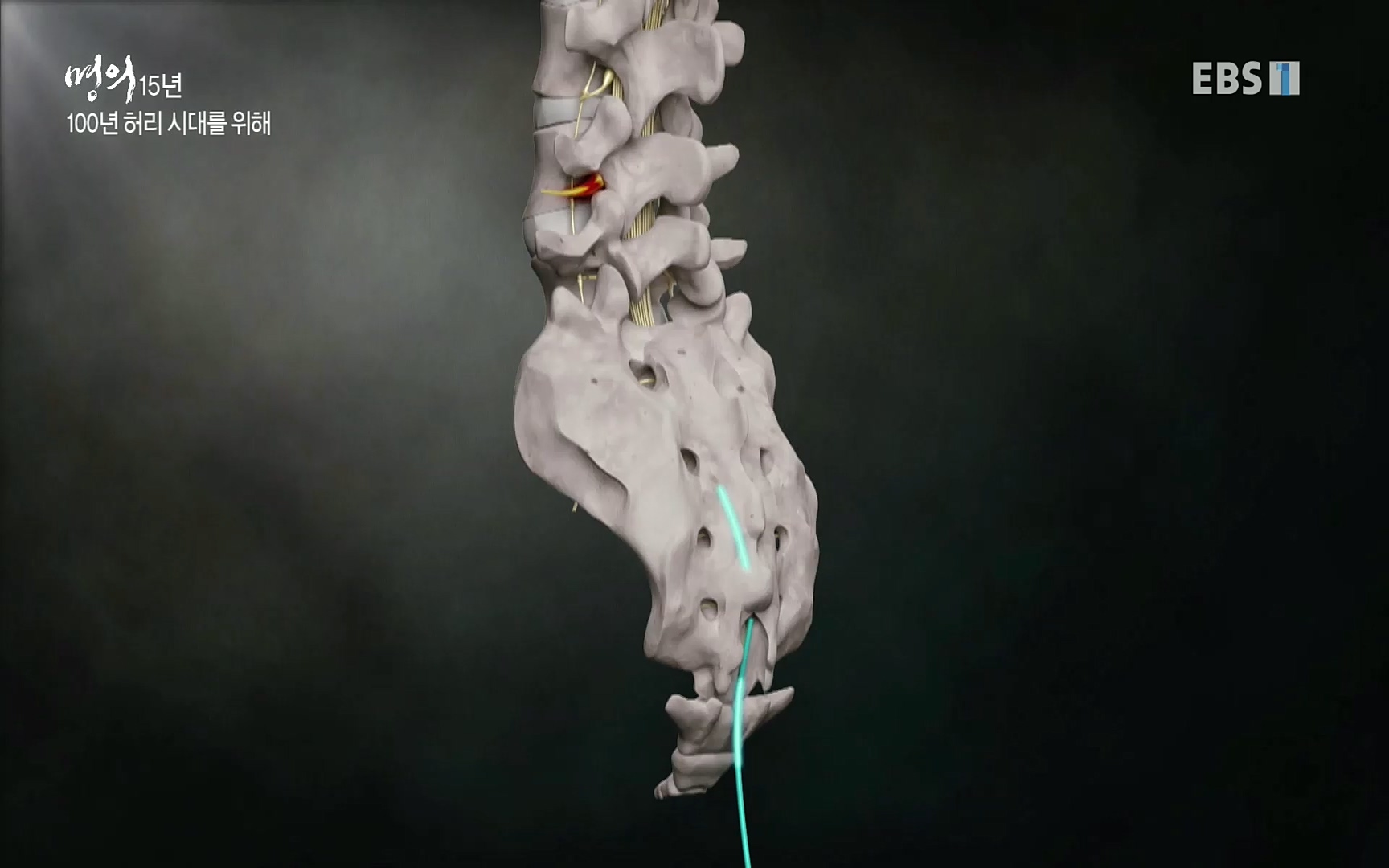 EBS 명의 헬스케어 - TV - 교육의 중심 EBS명의 15년 - 허리통증을 잡아라!.mp4_20220805_210313.493.jpg